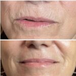 Plasma facial treatment for skin aesthetics. Non invasive Skin tightening & wrinkles reverse, offering a non-surgical face-lift and rejuvenated face. Botox alterantive.