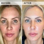 Plasma facial treatment for skin aesthetics. Non invasive Skin tightening & wrinkles reverse, offering a non-surgical face-lift and rejuvenated face. Botox alterantive.