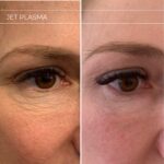 Plasma facial treatment for advanced skin aesthetics. This non-invasive solution tightens the skin and reverses wrinkles, delivering a natural non-surgical face-lift and a rejuvenated appearance. It also acts as a safe Botox alternative. In addition, our laser technology targets anti-aging, skin rejuvenation, and pigmentation for visible, lasting results.
