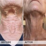 Plasma facial treatment for skin aesthetics. Non invasive Skin tightening & wrinkles reverse, offering a non-surgical face-lift and rejuvenated face. Botox alterantive.