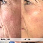 Plasma facial treatment for advanced skin aesthetics. This non-invasive solution tightens the skin and reverses wrinkles, delivering a natural non-surgical face-lift and a rejuvenated appearance. It also acts as a safe Botox alternative. In addition, our laser technology targets anti-aging, skin rejuvenation, and pigmentation for visible, lasting results.