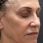 Plasma facial treatment for skin aesthetics. Non invasive Skin tightening & wrinkles reverse, offering a non-surgical face-lift and rejuvenated face. Botox alterantive.