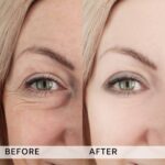 Plasma facial treatment for skin aesthetics. Non invasive Skin tightening & wrinkles reverse, offering a non-surgical face-lift and rejuvenated face. Botox alterantive.