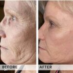 Plasma facial treatment for skin aesthetics. Non invasive Skin tightening & wrinkles reverse, offering a non-surgical face-lift and rejuvenated face. Botox alterantive.