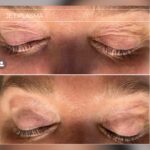 Plasma facial treatment for skin aesthetics. Non invasive Skin tightening & wrinkles reverse, offering a non-surgical face-lift and rejuvenated face. Botox alterantive.