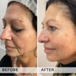Plasma facial treatment for skin aesthetics. Non invasive Skin tightening & wrinkles reverse, offering a non-surgical face-lift and rejuvenated face. Botox alterantive.