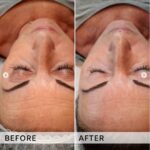 Plasma facial treatment for skin aesthetics. Non invasive Skin tightening & wrinkles reverse, offering a non-surgical face-lift and rejuvenated face. Botox alterantive.