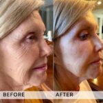 Plasma facial treatment for skin aesthetics. Non invasive Skin tightening & wrinkles reverse, offering a non-surgical face-lift and rejuvenated face. Botox alterantive.
