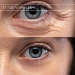 Plasma facial treatment for skin aesthetics. Non invasive Skin tightening & wrinkles reverse, offering a non-surgical face-lift and rejuvenated face. Botox alterantive.