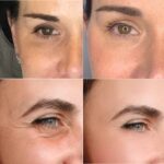 Plasma facial treatment for skin aesthetics. Non invasive Skin tightening & wrinkles reverse, offering a non-surgical face-lift and rejuvenated face. Botox alterantive.