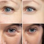 Plasma facial treatment for skin aesthetics. Non invasive Skin tightening & wrinkles reverse, offering a non-surgical face-lift and rejuvenated face. Botox alterantive.