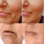 Plasma facial treatment for skin aesthetics. Non invasive Skin tightening & wrinkles reverse, offering a non-surgical face-lift and rejuvenated face. Botox alterantive.