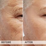 Plasma facial treatment for skin aesthetics. Non invasive Skin tightening & wrinkles reverse, offering a non-surgical face-lift and rejuvenated face. Botox alterantive.