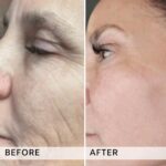 Plasma facial treatment for skin aesthetics. Non invasive Skin tightening & wrinkles reverse, offering a non-surgical face-lift and rejuvenated face. Botox alterantive.