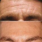 Plasma facial treatment for advanced skin aesthetics. This non-invasive solution tightens the skin and reverses wrinkles, delivering a natural non-surgical face-lift and a rejuvenated appearance. It also acts as a safe Botox alternative. In addition, our laser technology targets anti-aging, skin rejuvenation, and pigmentation for visible, lasting results.