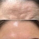 Plasma facial treatment for skin aesthetics. Non invasive Skin tightening & wrinkles reverse, offering a non-surgical face-lift and rejuvenated face. Botox alterantive.