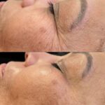 Plasma facial treatment for skin aesthetics. Non invasive Skin tightening & wrinkles reverse, offering a non-surgical face-lift and rejuvenated face. Botox alterantive.