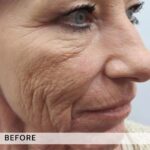 Plasma facial treatment for advanced skin aesthetics. This non-invasive solution tightens the skin and reverses wrinkles, delivering a natural non-surgical face-lift and a rejuvenated appearance. It also acts as a safe Botox alternative. In addition, our laser technology targets anti-aging, skin rejuvenation, and pigmentation for visible, lasting results.