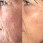 Plasma facial treatment for advanced skin aesthetics. This non-invasive solution tightens the skin and reverses wrinkles, delivering a natural non-surgical face-lift and a rejuvenated appearance. It also acts as a safe Botox alternative. In addition, our laser technology targets anti-aging, skin rejuvenation, and pigmentation for visible, lasting results.