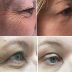 Plasma facial treatment for skin aesthetics. Non invasive Skin tightening & wrinkles reverse, offering a non-surgical face-lift and rejuvenated face. Botox alterantive.