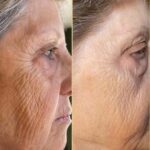 Plasma facial treatment for skin aesthetics. Non invasive Skin tightening & wrinkles reverse, offering a non-surgical face-lift and rejuvenated face. Botox alterantive.