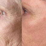 Plasma facial treatment for skin aesthetics. Non invasive Skin tightening & wrinkles reverse, offering a non-surgical face-lift and rejuvenated face. Botox alterantive.