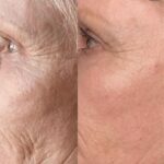 Plasma facial treatment for skin aesthetics. Non invasive Skin tightening & wrinkles reverse, offering a non-surgical face-lift and rejuvenated face. Botox alterantive.