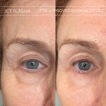 Plasma facial treatment for skin aesthetics. Non invasive Skin tightening & wrinkles reverse, offering a non-surgical face-lift and rejuvenated face. Botox alterantive.