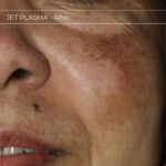 Plasma facial treatment for skin aesthetics. Non invasive Skin tightening & wrinkles reverse, offering a non-surgical face-lift and rejuvenated face. Botox alterantive.