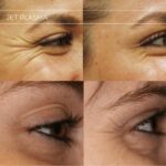 Plasma facial treatment for skin aesthetics. Non invasive Skin tightening & wrinkles reverse, offering a non-surgical face-lift and rejuvenated face. Botox alterantive.