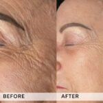 Plasma facial treatment for skin aesthetics. Non invasive Skin tightening & wrinkles reverse, offering a non-surgical face-lift and rejuvenated face. Botox alterantive.