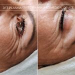Plasma facial treatment for skin aesthetics. Non invasive Skin tightening & wrinkles reverse, offering a non-surgical face-lift and rejuvenated face. Botox alterantive.