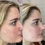 Plasma facial treatment for advanced skin aesthetics. This non-invasive solution tightens the skin and reverses wrinkles, delivering a natural non-surgical face-lift and a rejuvenated appearance. It also acts as a safe Botox alternative. In addition, our laser technology targets anti-aging, skin rejuvenation, and pigmentation for visible, lasting results.
