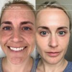 Plasma facial treatment for skin aesthetics. Non invasive Skin tightening & wrinkles reverse, offering a non-surgical face-lift and rejuvenated face. Botox alterantive.