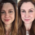 Plasma facial treatment for skin aesthetics. Non invasive Skin tightening & wrinkles reverse, offering a non-surgical face-lift and rejuvenated face. Botox alterantive.