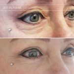 Plasma facial treatment for skin aesthetics. Non invasive Skin tightening & wrinkles reverse, offering a non-surgical face-lift and rejuvenated face. Botox alterantive.