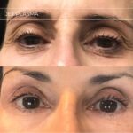 Plasma facial treatment for skin aesthetics. Non invasive Skin tightening & wrinkles reverse, offering a non-surgical face-lift and rejuvenated face. Botox alterantive.