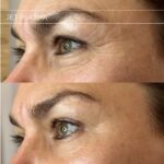 Plasma facial treatment for skin aesthetics. Non invasive Skin tightening & wrinkles reverse, offering a non-surgical face-lift and rejuvenated face. Botox alterantive.