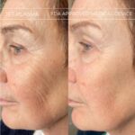 Plasma facial treatment for skin aesthetics. Non invasive Skin tightening & wrinkles reverse, offering a non-surgical face-lift and rejuvenated face. Botox alterantive.