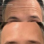Plasma facial treatment for skin aesthetics. Non invasive Skin tightening & wrinkles reverse, offering a non-surgical face-lift and rejuvenated face. Botox alterantive.