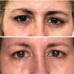 Plasma facial treatment for skin aesthetics. Non invasive Skin tightening & wrinkles reverse, offering a non-surgical face-lift and rejuvenated face. Botox alterantive.