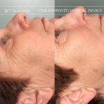 Plasma facial treatment for skin aesthetics. Non invasive Skin tightening & wrinkles reverse, offering a non-surgical face-lift and rejuvenated face. Botox alterantive.