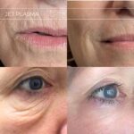 Plasma facial treatment for skin aesthetics. Non invasive Skin tightening & wrinkles reverse, offering a non-surgical face-lift and rejuvenated face. Botox alterantive.