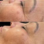 Plasma facial treatment for skin aesthetics. Non invasive Skin tightening & wrinkles reverse, offering a non-surgical face-lift and rejuvenated face. Botox alterantive.