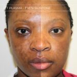 Plasma facial treatment for skin aesthetics. Non invasive Skin tightening & wrinkles reverse, offering a non-surgical face-lift and rejuvenated face. Botox alterantive.