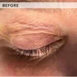 Plasma facial treatment for skin aesthetics. Non invasive Skin tightening & wrinkles reverse, offering a non-surgical face-lift and rejuvenated face. Botox alterantive.