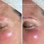 Plasma facial treatment for skin aesthetics. Non invasive Skin tightening & wrinkles reverse, offering a non-surgical face-lift and rejuvenated face. Botox alterantive.