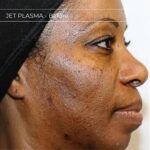 Plasma facial treatment for skin aesthetics. Non invasive Skin tightening & wrinkles reverse, offering a non-surgical face-lift and rejuvenated face. Botox alterantive.