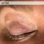 Plasma facial treatment for advanced skin aesthetics. This non-invasive solution tightens the skin and reverses wrinkles, delivering a natural non-surgical face-lift and a rejuvenated appearance. It also acts as a safe Botox alternative. In addition, our laser technology targets anti-aging, skin rejuvenation, and pigmentation for visible, lasting results.