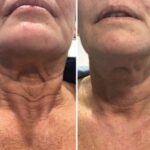 Plasma facial treatment for skin aesthetics. Non invasive Skin tightening & wrinkles reverse, offering a non-surgical face-lift and rejuvenated face. Botox alterantive.